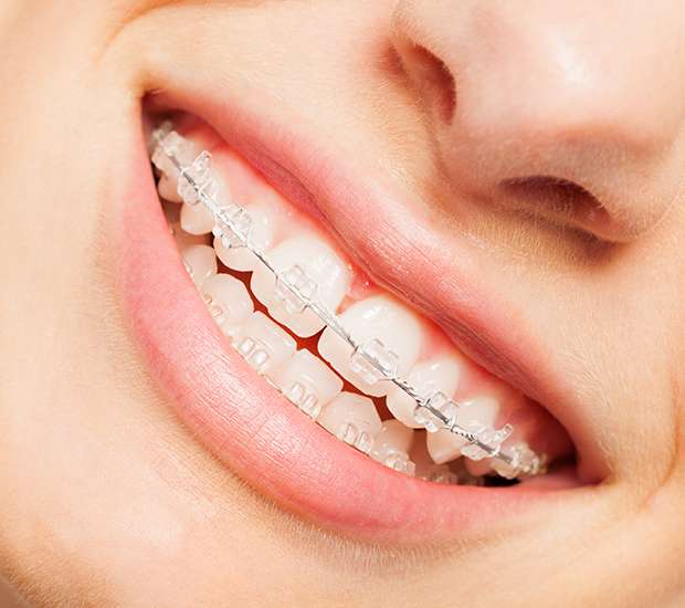 Paris Clear Braces
