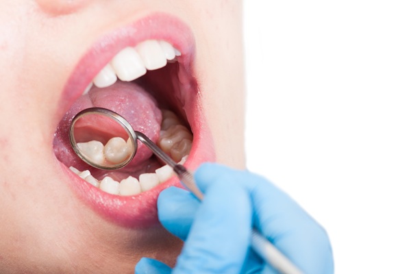 When Can I Eat After Getting A Dental Filling?