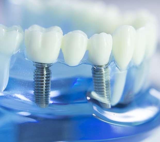Paris Dental Implants