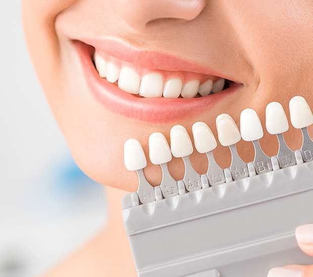 Paris Dental Veneers and Dental Laminates